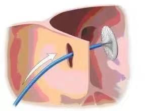 小心眼|花季少女剧烈头痛反复发作，病因竟是她的“小心眼”？！