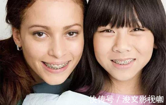 儿童|儿童牙齿矫正的黄金时期,家长们不要错过了!