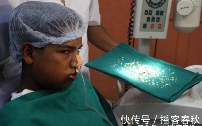 怪物|七岁男孩嘴中有526颗牙齿,医生花费5小时取出,和怪物没区别