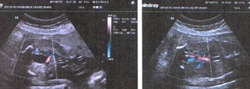 孕妈|孕期，若是怀了“小王子”，孕妈产检单上可能会出现3个“数据”