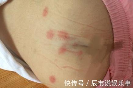 蛲虫|3岁女儿总去挠“屁屁”,妈妈不放心检查一下,鸡皮疙瘩都起来了