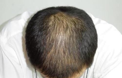 肾阳虚|肾虚的6种主要表现,最后1条,很多人都躲不掉!