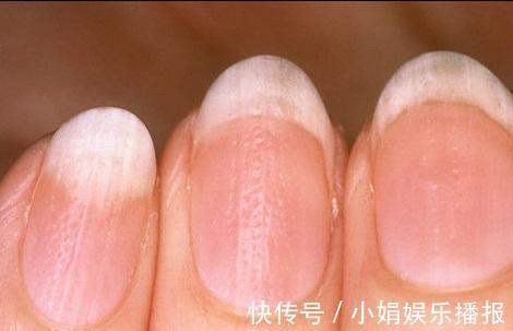 黄甲综合征|身体有问题,指甲告诉你!指甲出现9种变化,恐是疾病来袭