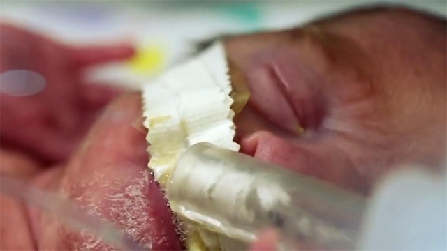 胎儿|早产儿仅1斤,医生称存活几率低,宝宝的举动感动众人