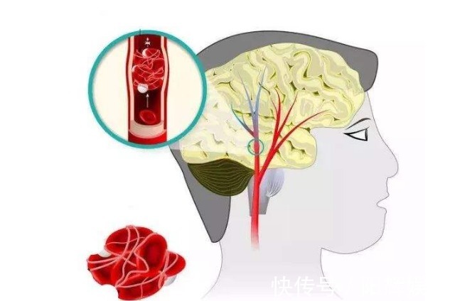 脑中风|第14个世界卒中日，5个脑中风预兆要注意，紧急时刻能救命