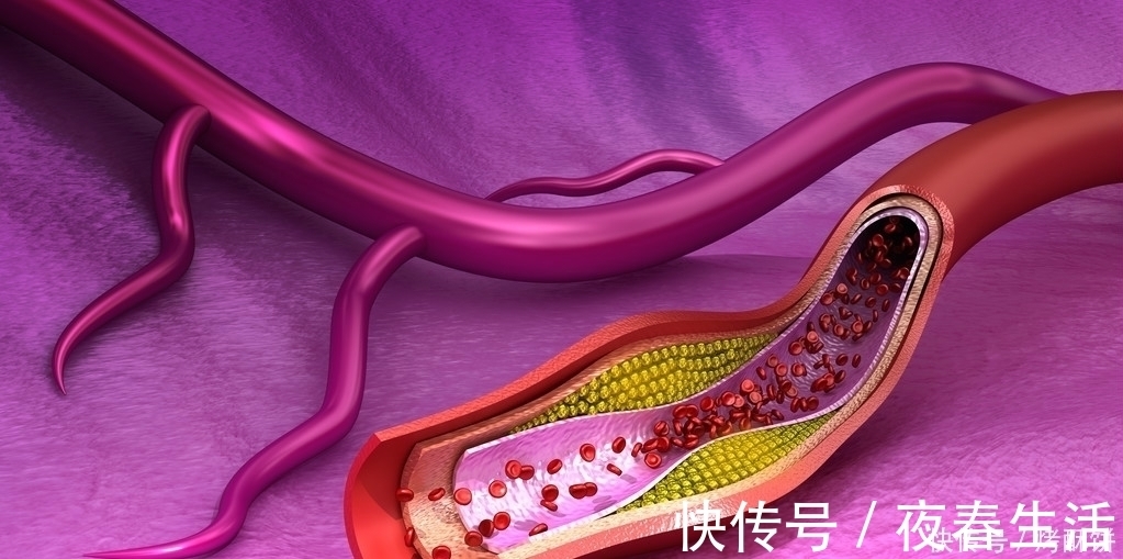 动脉粥样硬化|血管一天比一天狭窄，三种食物最好多吃一点，能离脑血栓更远