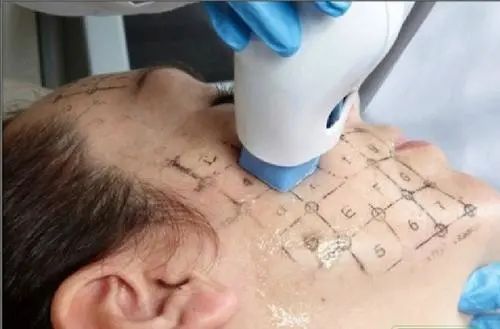 有效率|夏季适合做热玛吉吗?丨科普篇