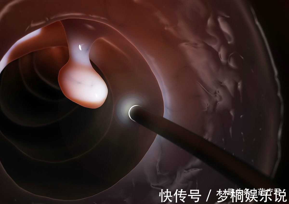 肠癌|肠子里长息肉后,身体会有什么感觉?为什么切了息肉还会得肠癌?