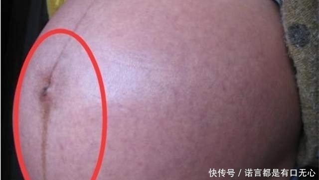 秘密|怀孕后肚子上的“黑线”是什么？妊娠中线的秘密，你有必要了解