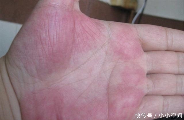 肝脏|肝不好的人,手上可能有这3个表现,记住3个动作,肝慢慢变好