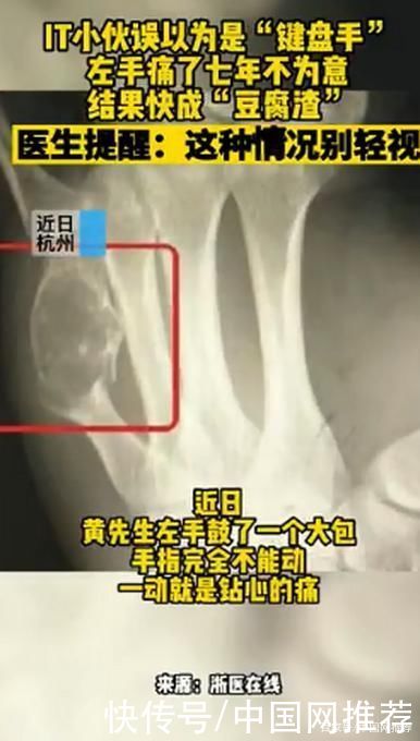 医生|杭州一程序员手疼7年没在意，医生:骨头快成“豆腐渣”了