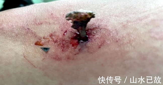惠阳三和医院|别边走路边玩手机了!一孕妇低头玩手机撞墙,鱼骨扎进大腿8cm