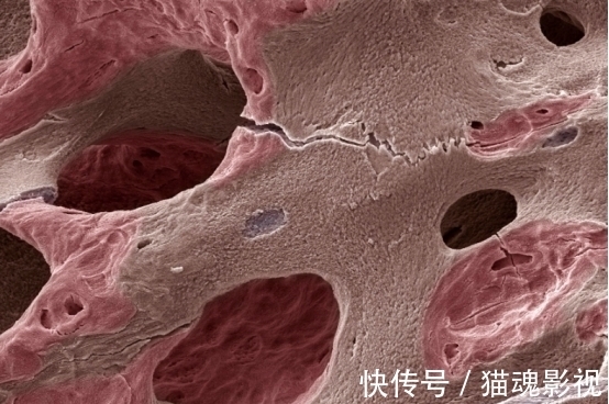 草酸|骨骼一碰就碎，骨科医生提醒：3种 食物或许是“脆骨剂”，别贪吃