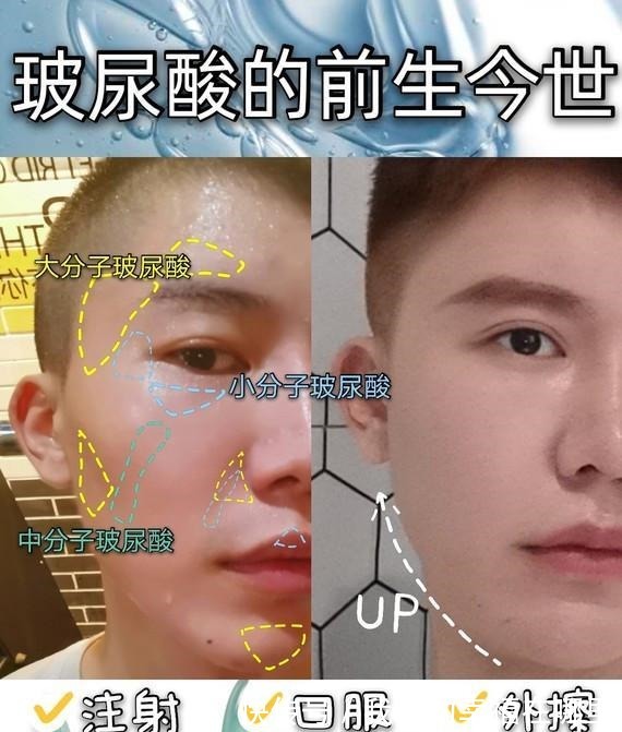 分子量 玻尿酸的前生今世!护肤、口服、医美,竟然连TT里面都有添加!