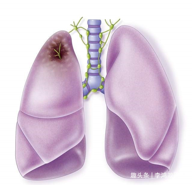 蛋白质|女子双脚水肿，诊断肾病综合征，直到出现咳嗽医生才发现是肺癌