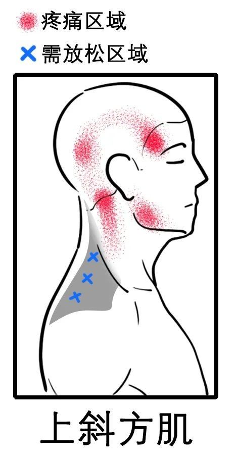 颈椎|八成头痛和颈椎有关！一份“疼痛位置图解”帮你对症放松