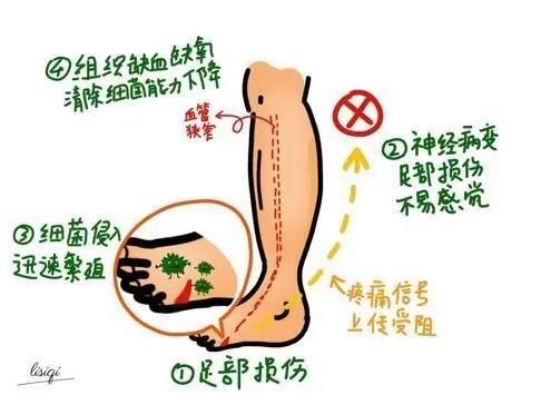 红肿|?长沙50岁男子足部红肿没重视，结果差点要截肢