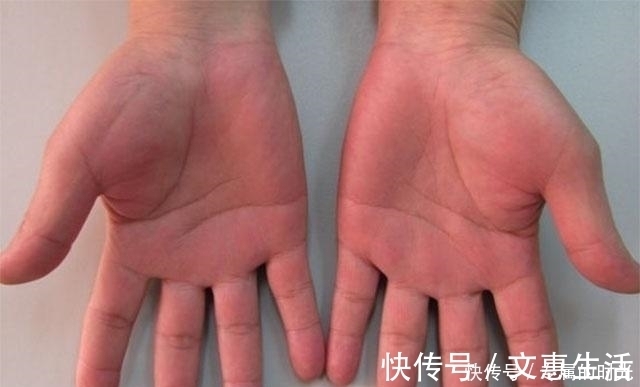 发红|肝受损,人体会有“3红1热”,若有,要学会养肝了