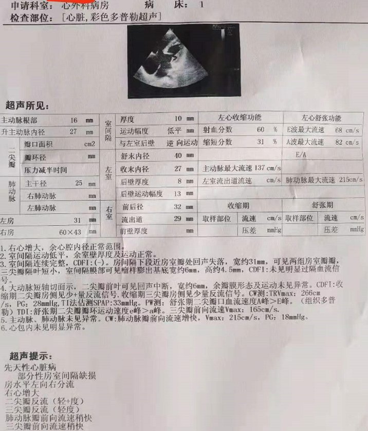 二尖瓣|“补心”成功!潍坊市中医院修补残缺的心内“十字架”
