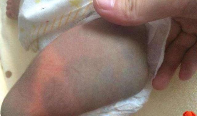 屁股|宝宝身上有淤青是来给父母报恩的如果胎记长成这样,家长要重视