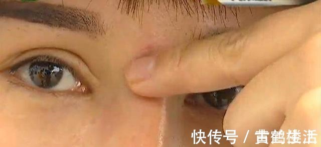 鼻峰|美女为漂亮整容,一年后鼻子歪了,眼睛也成了三角眼!商家碰瓷!