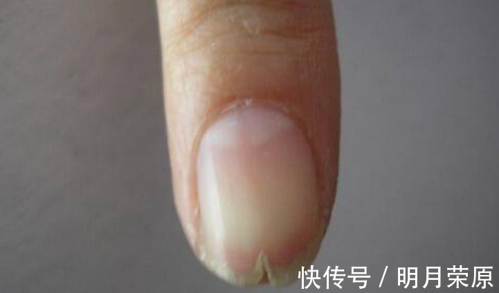 肝脏|肝脏没有痛觉，发现就是晚期！手上出现3种信号，提示你病变了