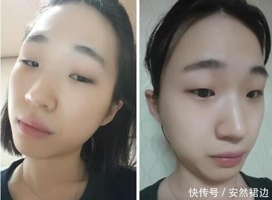 小脸确实更可爱,看完整容过程,只觉得满屏的疼痛