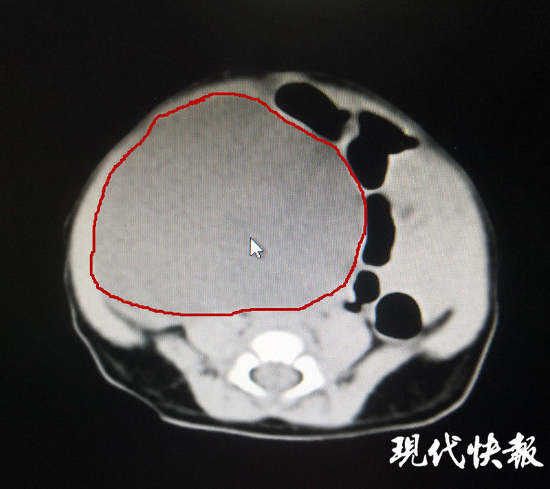 产检|新生宝宝患卵巢囊肿，产检时就发现了