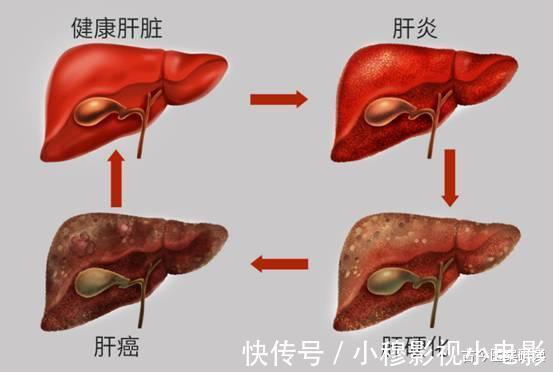 肝癌|36岁女子转氨酶高达391,确诊肝癌,医生告诫:一种家常菜是“祸根”