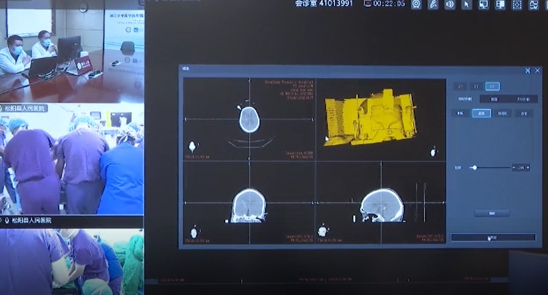 神经外科|“空中”手术室来了 5G+机器人将200公里外血肿清除