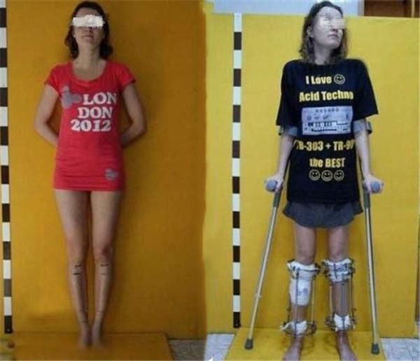 孩子|男孩为当飞行员花16万断骨增高,多年后,因“长高”毁掉人生