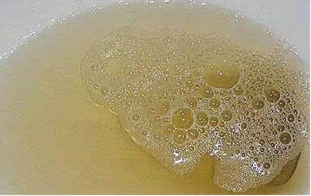 大便|肝病不能“拖延”,若上厕所有3个表现,肝可能在向你“求救”