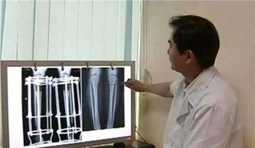 身高|为了长高7.2厘米,花16万做断骨手术的少年李亚诺,如今彻夜难眠