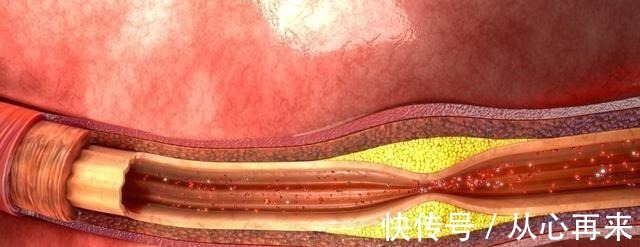 心脑血管|每天早上吃一个水煮蛋,对身体到底好不好?医生这回说了良心话