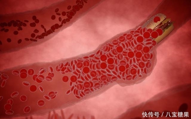 血栓最怕这3个“动作”,坚持下去,血管很干净