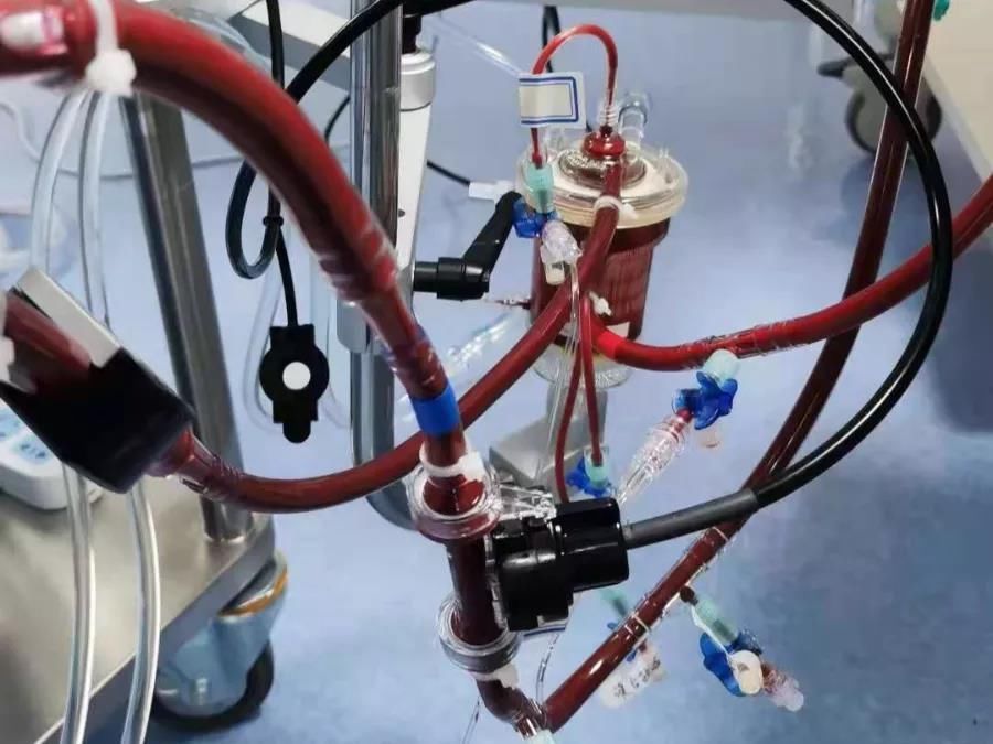 ecmo|吸入胎粪,新生儿出生后8小时呼吸衰竭,4天“人工肺”让小宝贝转危为安