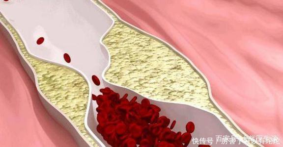 甘油三脂的“克星”找到了，不是洋葱，每天可劲吃，血脂稳稳降
