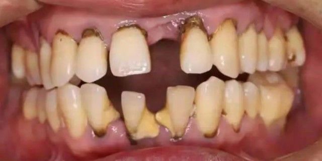 小伙|“我才30多岁啊!”杭州小伙张开嘴,医生一句话让他直掉泪:全都保不住了