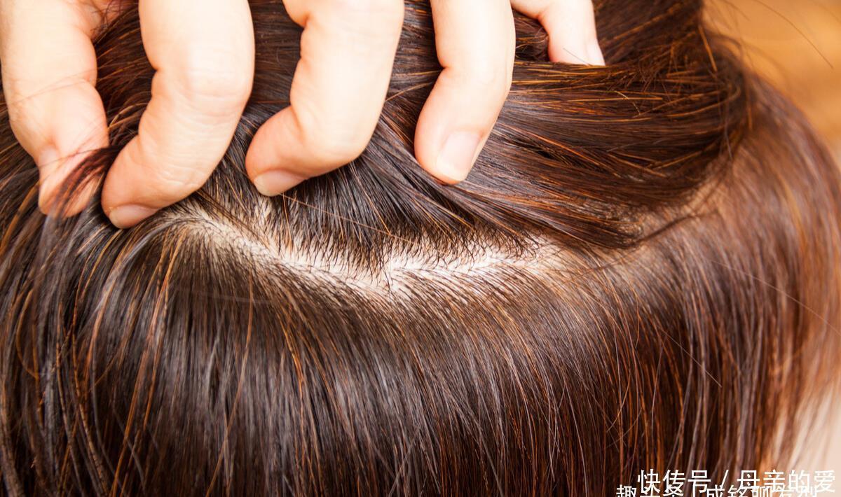 风险|头发染什么颜色,过敏风险最小?做好皮肤测试,才能放心染发