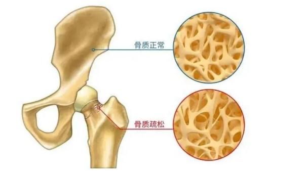 骨质疏松|大二男生掰手腕时粉碎性骨折！你的骨头没想象的那么“硬”