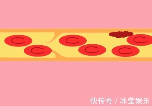 血管|3种调味剂,比糖和盐更“伤身”你或许经常吃,怪不得血管会堵