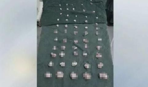 子宫|38岁女性腹痛不止，大夫在她子宫里取出大大小小61个，从未遇到过