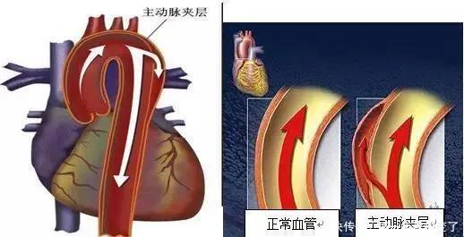  “定时炸弹”主动脉夹层动脉瘤，差点要了这位快递小哥的命