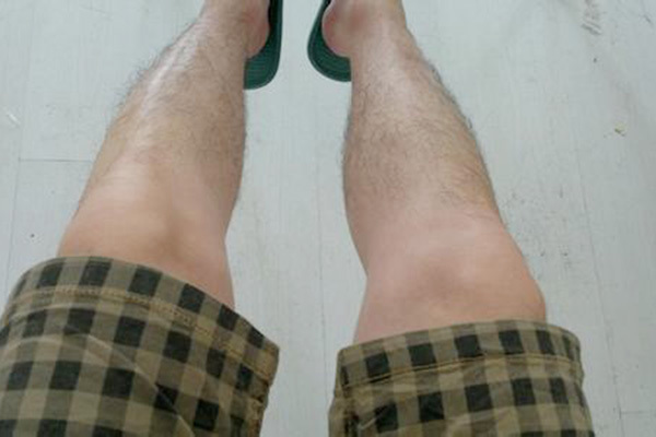 激光脱毛|为什么有的男人腿毛旺盛,而有的却“光秃秃”原因有哪些