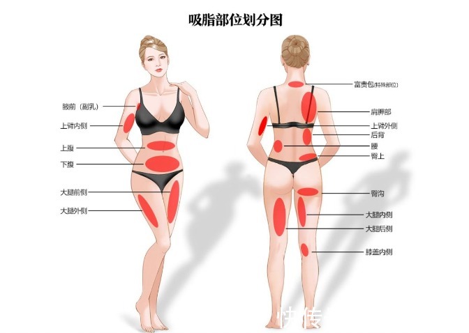 小手术 吸脂手术后穿塑身衣,居然有这么多细节需要注意?