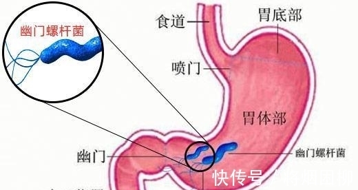 穷癌|胃癌为什么叫做穷癌?富人就不会得胃癌吗?