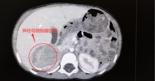 1岁女童患巨大肿瘤家长竟不知！医生一个动作救命