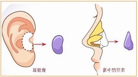 鼻翼肥大 双侧耳软骨隆鼻可以维持多久？术后可以永久保持吗？