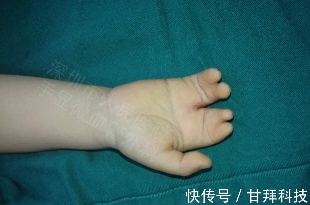 男孩|得了这病,12岁男孩手指比香蕉还粗!7种常见的手部畸形,家长们要注意