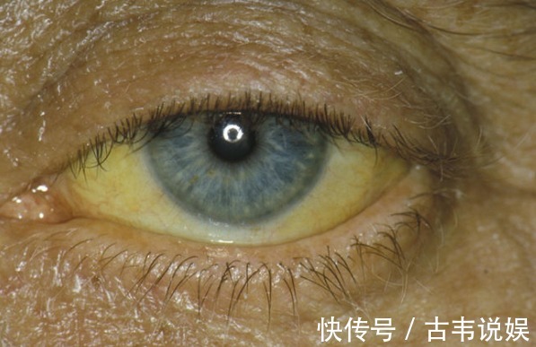 肝炎|“肝不肝净”,眼睛会“说话”,有这4种“迹象”,肝炎或已来袭